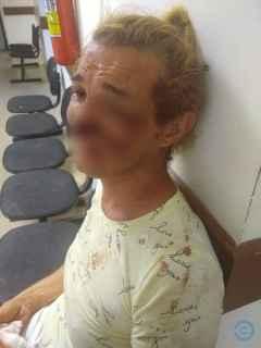 Mulher trans é brutalmente espancada e tem parte do nariz arrancado