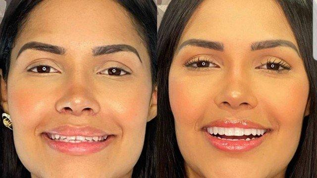 De sorriso novo: Flay mostra resultado de novas lentes