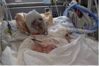 Jovem de 22 anos é primeira pessoa a sobreviver transplante de mãos e rosto